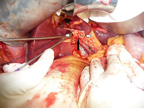 Orifice of the left- and right-sided double ducts after transection distal to the hepatic confluence.