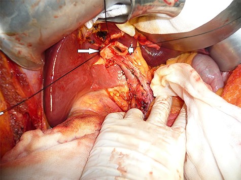 Opened hepatic confluence showing left (short arrow) and right hepatic (long arrow) duct orifices.