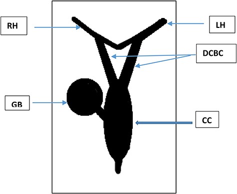 Schematic illustration of the variant described. LH: left hepatic duct, RH: right hepatic duct, DCBD: double bile duct originating from the hepatic duct confluence, CC: fusiform cyst formed at the distal unified portion of the DCBC, GB: gallbladder emptying into the CC.