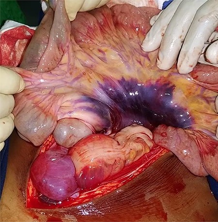 Diffuse mesenteric hematoma.