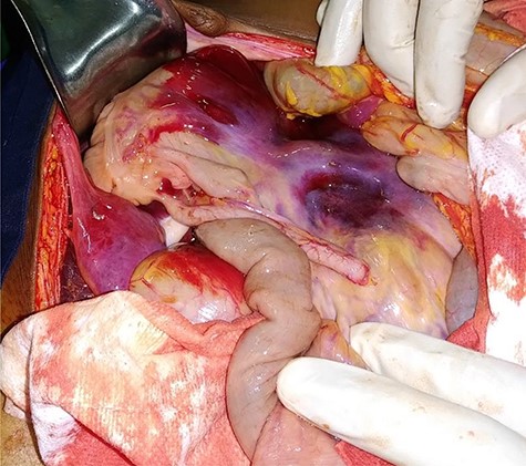 Diffuse mesocolic hematoma.