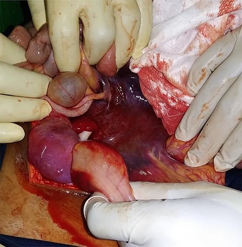 Diffuse mesosigmoid hematoma.