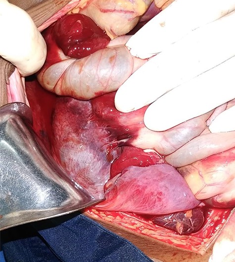 Right Toldt’s fascia diffuse hematoma.