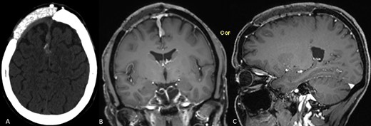 (A–C) Preoperative neuroimaging shows recurrent meningioma along the falx cerebri and under the cranioplasty (A: native CT scan, axial plane; B: contrast-enhanced MRI, coronal plane; C: contrast-enhanced MRI, sagittal plane).