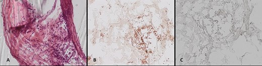 (A–C) Histological work-up of the explanted cranioplasty: (A) hematoxylin/eosin staining, immunohistochemical staining for (B) epithelial membrane antigen, and (C) GFAP (all ×20 magnification).