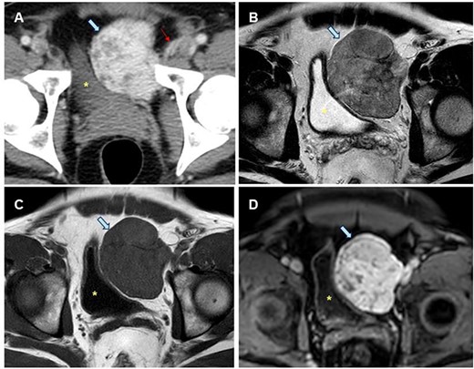 Radiological study of the pelvic mass. (A) CT scan with intravenous contrast: hypervascular mass (blue arrow). Epigastric vessels give vascular supply, coming from left common femoral artery (thin red arrow). (B, C, D). MRI in late T2-FSE (B), T1-FSE (C) and T1-FAT-SAT GD sequences. Hypointense mass both in T1 and T2 sequences without intravenous contrast suggesting the fibrous origin. It is confirmed in T1 sequence with fat saturation and after intravenous gadolinium administration is homogeneous, in late phase (8 min). Bladder is displaced towards the opposite side (yellow dot).