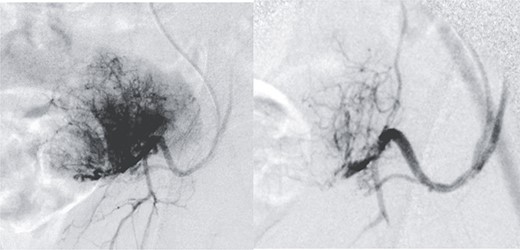 Presurgical tumor embolization. (A) By contralateral approach, left femoral diagnostic angiography is performed, showing hypervascular tumor pattern depending on the left epigastric artery. (B) Control after embolization of the two medial thirds of the tumor with calibrated particles of 600 +/− 75 microns. The rest of the tumor cannot be safely embolized due to the existence of obturator branches.