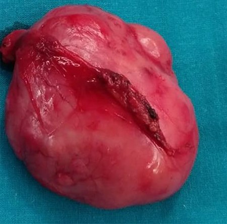 Macroscopic description: round and smooth brownish well delimited 6 cm in diameter solid lesion with homogeneous fibrous appearance. No signs of macroscopic necrosis are evident.