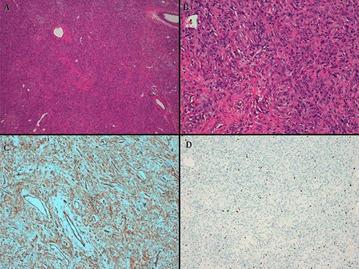 (A) hematoxylin–eosin, 4×. Slightly storiform diffuse proliferation. (B) HE, 20×. Fusiform cells with oval nuclei and extracellular collagen deposit. (C) CD34. (D). Ki67.