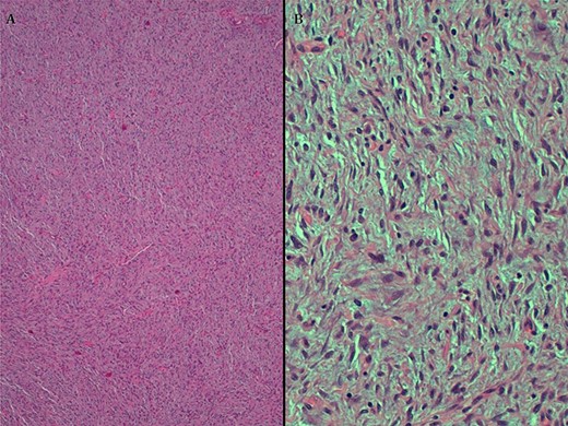 A. HE, 4x. Cells with diffuse growth. B. HE, 20x. Fusocellular neoplasia with clear eosinophilic cytoplasm and homogeneous elongated nuclei.