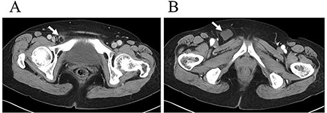 Contrast-enhanced computed tomography showed a hypodense rounded lesion (A, arrow) medial to the right femoral vessels with fluid collection (B, arrow).