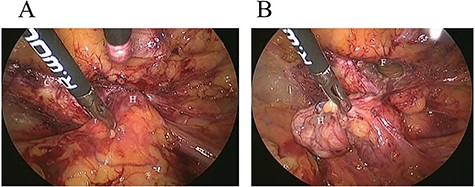Intraoperative findings. A: The hernia sac (H) had herniated into the right femoral canal. B: The hernia sac (H) was released from the femoral canal (F) with laparoscopic forceps.