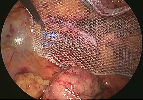 Intraoperative findings (2). Polypropylene mesh was placed in the preperitoneal space. Hernia sac (H).