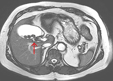 Axial view of the liver and gallbladder from a cardiac MRI showing a tubular structure entering the gallbladder at the level of the body in keeping with an accessory cystic duct (highlighted by the arrow).
