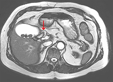 Axial view of the liver and gallbladder from a cardiac MRI showing the normal location of the cystic duct entering Hartmann’s pouch (highlighted by the arrow), which is separate and distinct from the structure shown in figure 1.