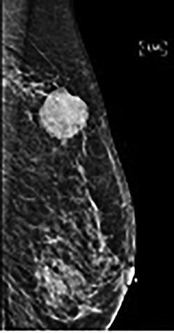 Mammography of palpable mass.