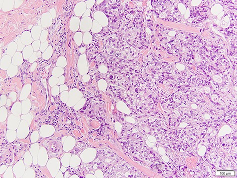 Infiltration of high-grade poorly differentiated malignant cells from breast biopsy.