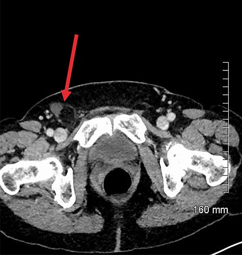 Axial contrast-enhanced CT showing hernial sac containing fat and simple fluid but no appendix (red arrow).