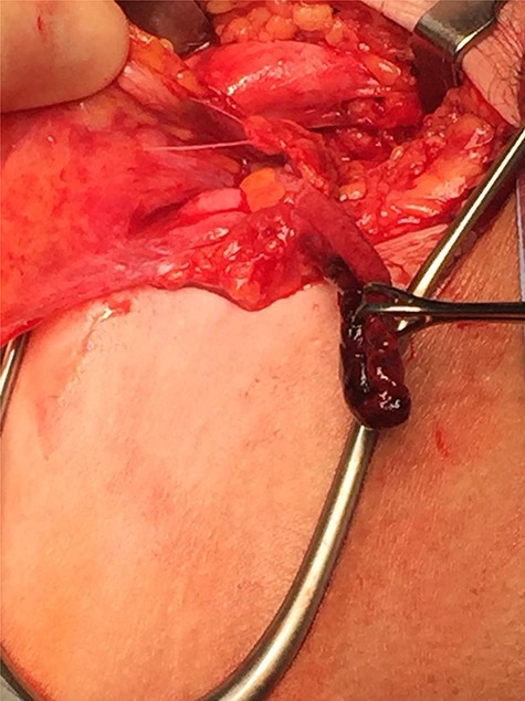 Gangrenous appendix revealed following opening of femoral hernia sac.