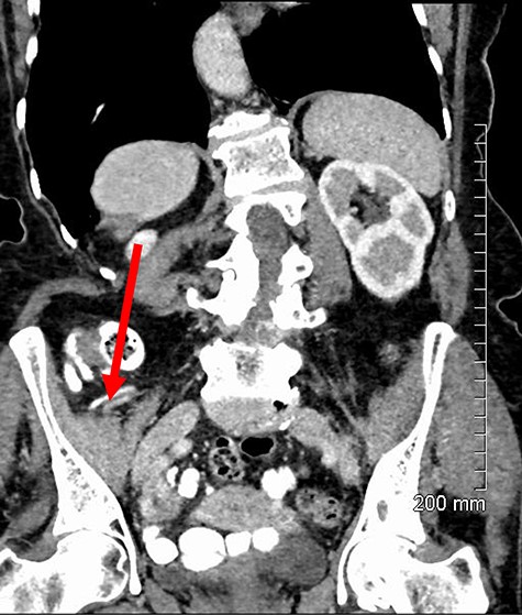 Sagittal contrast-enhanced CT showing a retrocecal appendix (red arrow) discreet from the observed hernia.