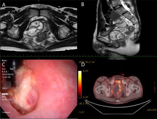 Magnetic resonance imaging (MRI) showed an enlarged, heterogeneous mass of 5.5 cm in the right prostate lobe (A, B), and vesical invasion was suspected by cystoscopy (C), besides positron emission tomography-computerized tomography and colonoscopy revealed rectal invasion of the tumor (D).
