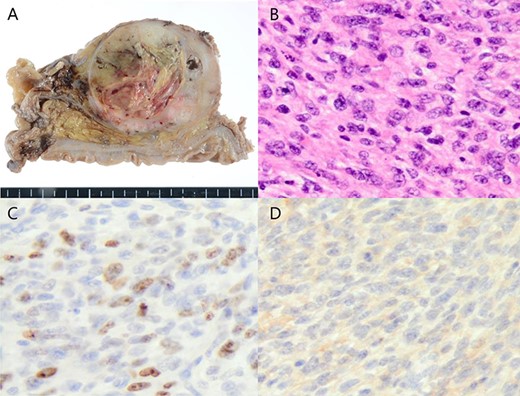 Macrospically, a 55 × 55 × 50-mm soft solid tumor with necrosis and a bleeding smooth surface was visible in the prostate (A), microscopically, the tumor was growing with invasive potential (B), and immunohistochemical results showed that CD34 were slightly positive (C), besides the Ki-67 labeling index was 20% (D).
