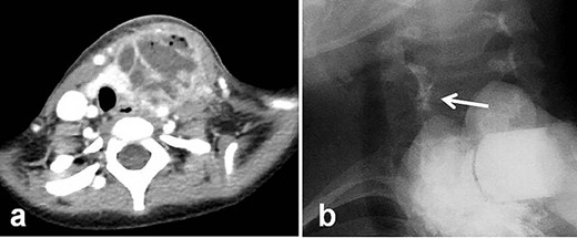 Radiologic examinations. (a) Enhanced computed tomography showing a huge abscess. (b) At the second hospitalization, direct fistulography from the wound showed an obvious fistula from the abscess cavity to the left pyriform sinus (white arrow: fistula).