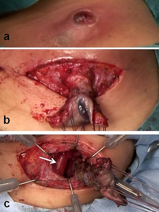 Intraoperative findings with open-neck sugary. (a) At the third hospitalization, a recurrent pyriform sinus fistula with abscess was demonstrated. (b) After direct injection of contrast medium and indigo carmine into the abscess cavity, an open-neck surgical procedure was done with coring out of the fistula stained with a dye. (c) A fistula being missed near the upper lobe of the left thyroid and the scar tissue with abscess (white arrow; left thyroid).