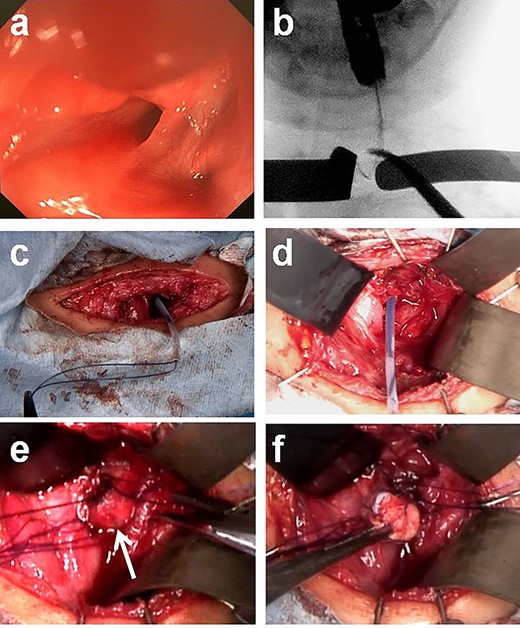 Intraoperative findings with treatment of a pyriform sinus fistula. (a) Orifice of the sinus fistula in the left pyriform sinus. (b) A guide wire was successfully inserted through the endoscope into the fistula, and the wire was gripped with forceps under fluoroscopic guidance. (c and d) A catheter was exchanged through the guide wire and a nylon thread was passed into the catheter. (e and f) After removing the nylon thread, the gauze ball was also removed.