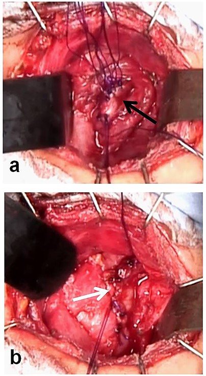 Closure of the orifice of the pyriform sinus fistula. (a) Closure of the thyropharyngeal part of the inferior constrictor of the pharynx (black arrow: the thropharyngeal part). (b) Closure of the cricopharyngeal part of the inferior constrictor of the pharynx (white arrow: the cricopharyngeal part).