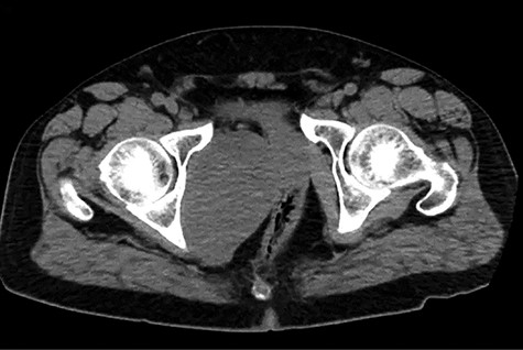 EHMC 10/21/19: 10.0 × 6.5 × 7.5-cm-sized right pelvic wall soft tissue mass.