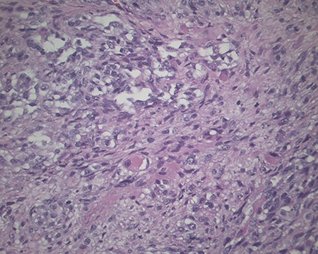 Magnification 200×. Chondroid differentiation.