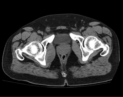HUMC CT 11/14/09: 3.3 × 6.6 × 3.0-cm-sized right pelvic wall soft tissue mass.