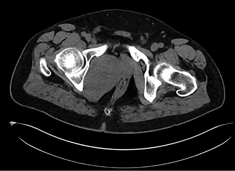 HUMC 6/1/19: 9.7 × 6.3 × 7.5-cm-sized right pelvic wall soft tissue mass.