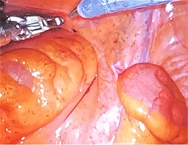 Dissection into the mesorectal space to open the anterior peritoneal reflection.