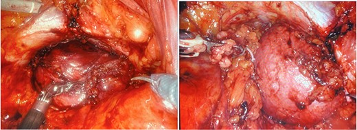 a and b. Robotic dissection of the mass from the right side of the rectum, pelvic bone, obturator canal, prostate, bladder and right seminal vesicle.