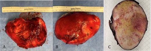 Gross pathology: A and B. 282-g nodular tumor mass, measuring 10.7 × 8.5 × 7 cm. The external surface covered by tan, fibrous tissue. Attached irregular, fibrous tissue measuring 7 × 2.5 cm. C. Black ink was applied on the external surface. Cut surfaces are light tan, firm, fibrotic appearing with focal yellow discoloration and soft flesh areas.