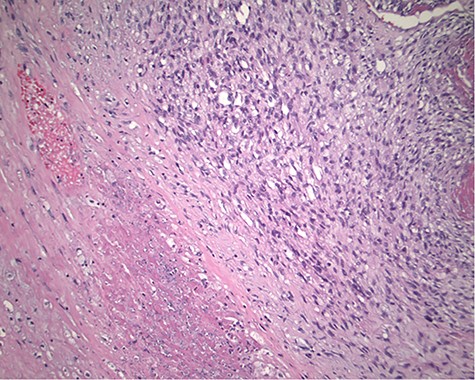 Magnification 100×. Cellular spindle cell neoplasm with focal necrosis.