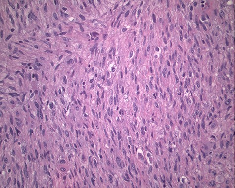 Magnification 200×. Fascicles of spindle cells with ovoid nuclei and eosinophilic nuclei.