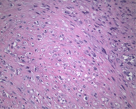 Magnification 200× Spindle cells with mild to moderate nuclear pleomorphism and focal rhabdomyoblastic differentiation.