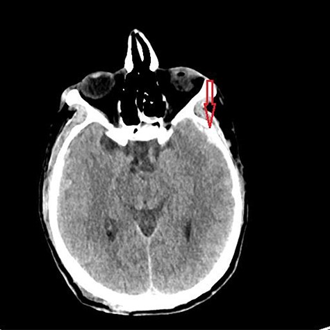 Initial CT head.