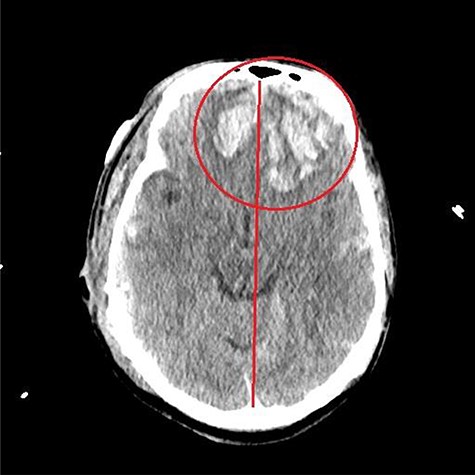 CT head post thoracotomy with expansion of contusion with shift.