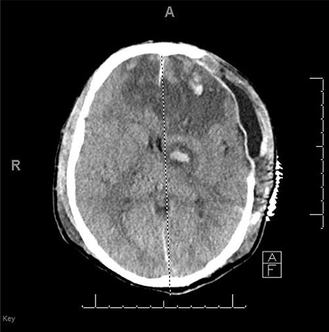 CT head POD3 from craniectomy.