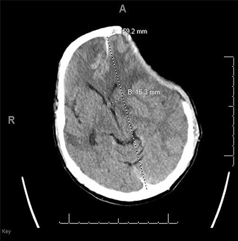 CT head POD26 from craniectomy demonstrating findings consistent with SSFS.