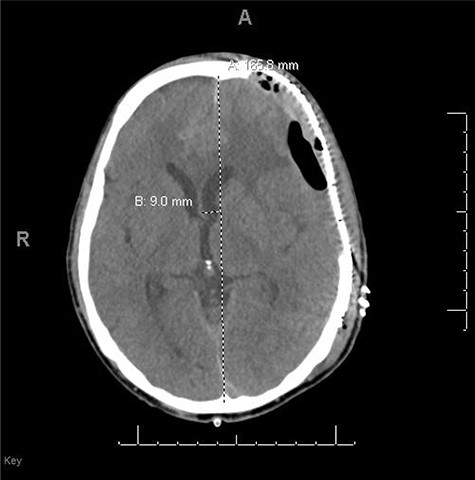 s/p cranioplasty.