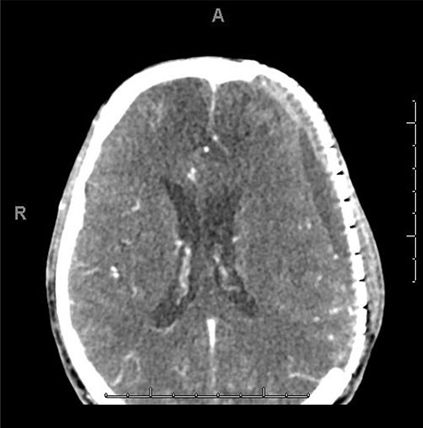POD15 from cranioplasty.