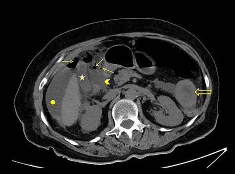 CT scan without intravenous (iv) and oral (per os) contrast media administration: The disruption of lumen continuity at the level of duodenum bulb with presence of fluid (arrow head) and free air (arrows). There are also presence of free fluid in subdiaphragmatic space (dot) and edema in jejunum wall (open arrow). Contracted gallbladder is noted by star.