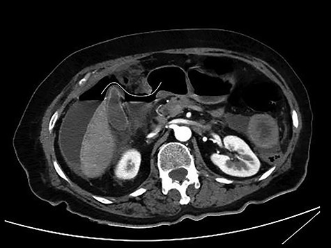 CT scan with iv and without per os contrast media administration: communication of free air with stomach (line).