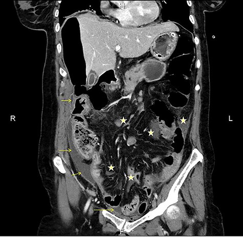 CT multiplanar reconstruction (upper level, supine position) shows free air in continuity with intraluminal (duodenum) air. Notice the presence of free fluid in mesenteric pouches (stars), as well as encapsulated in the right paracolic gutter (arrows) and Douglas space (long arrow).