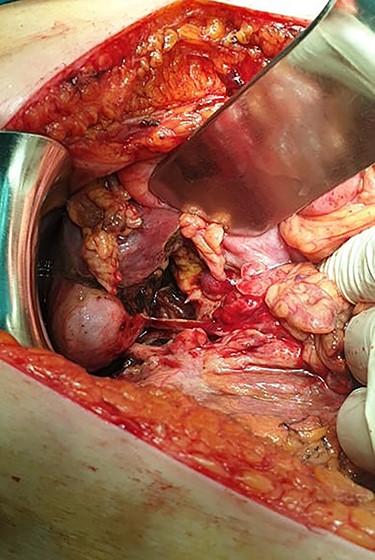 Intraoperative findings.